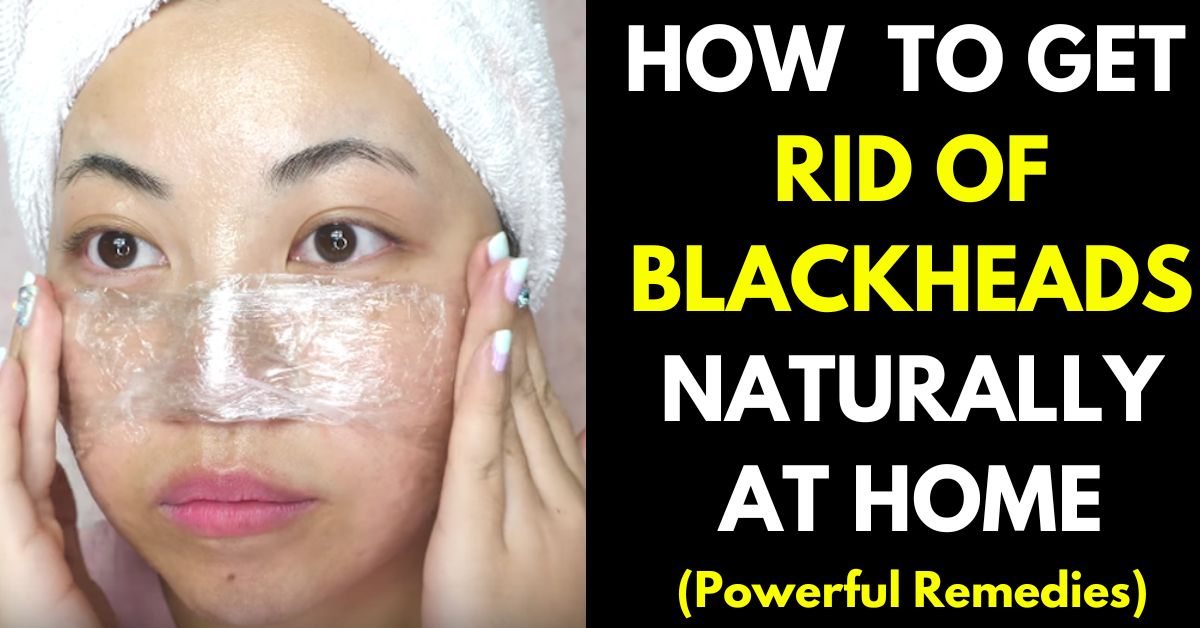 HOW get rid of blackhead naturally at home