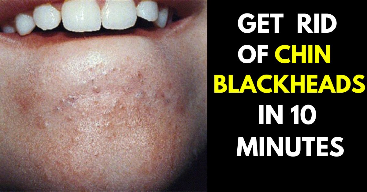 How to Get Rid of Chin Blackheads