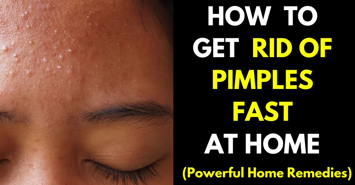 Home Remedies To Get Rid of Pimples | How to get rid of pimples, Home remedies, Pimples overnight