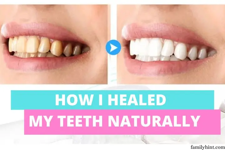 How I Healed My Teeth Naturally