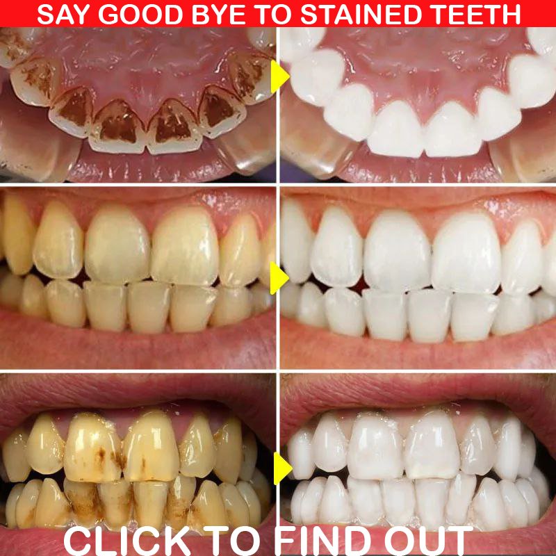 STAINED TEETH