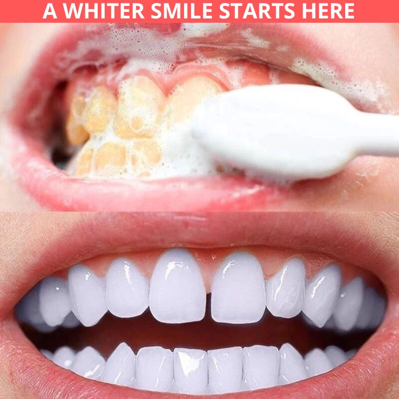 teeth whitening 3 2