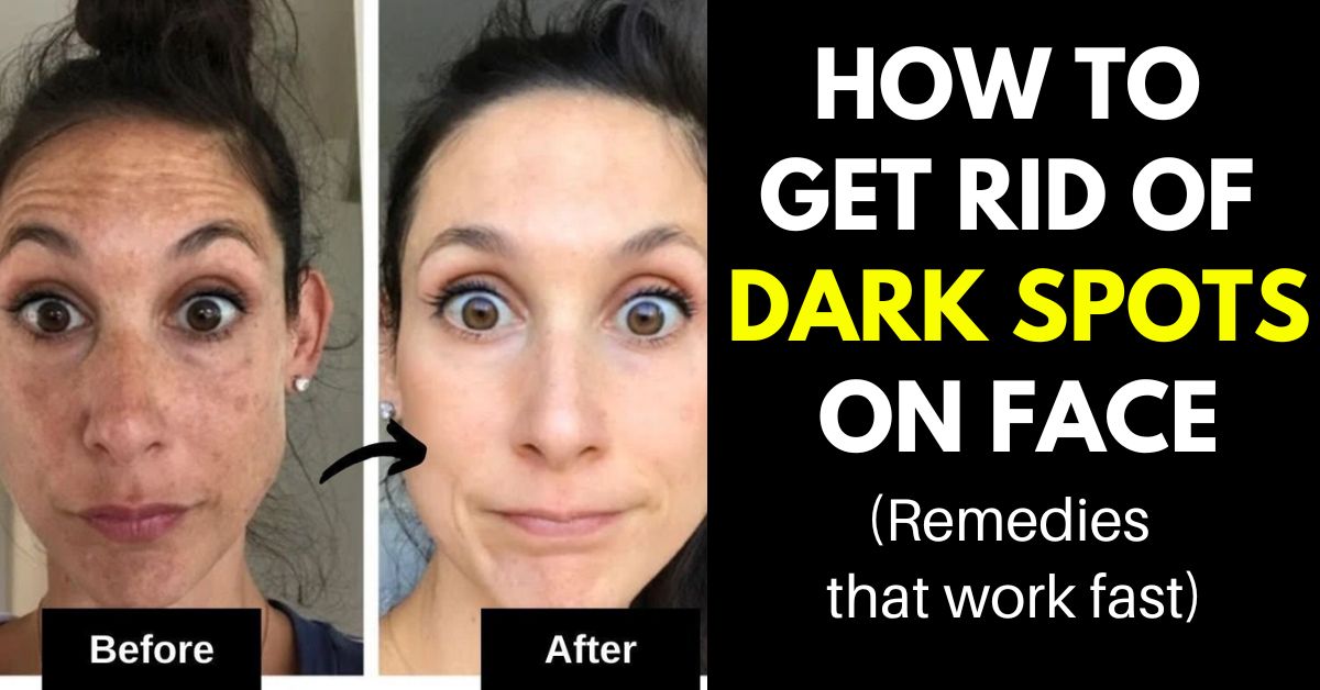 How to Get Rid of Dark Spots