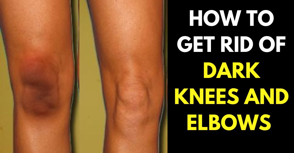 HOW TO GET RID OF DARK KNEES AND ELBOWS