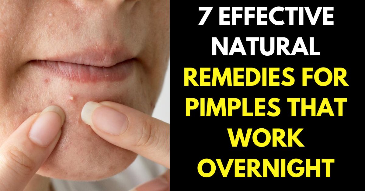 Natural Remedies for pimple