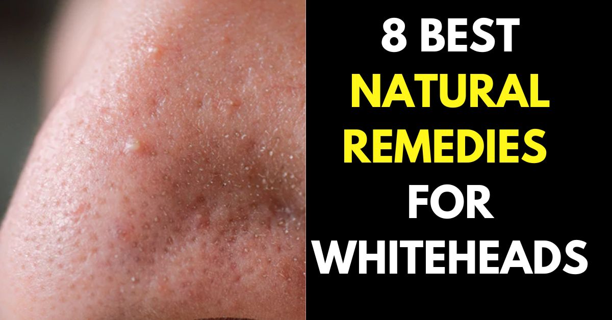 Natural Remedies to Remove Whiteheads