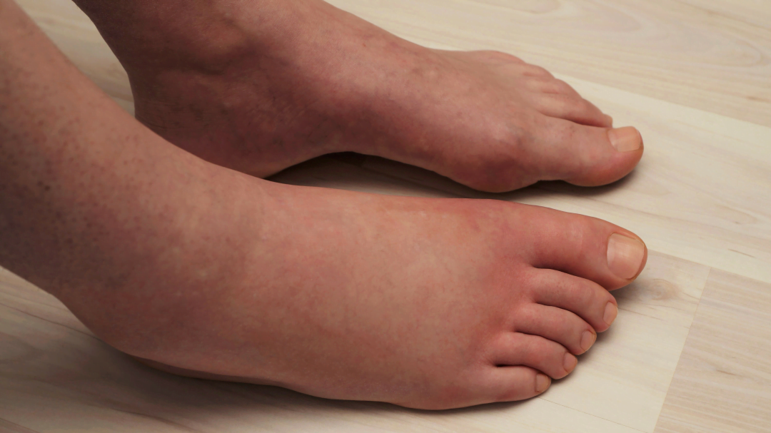home remedies for leg swelling or edema